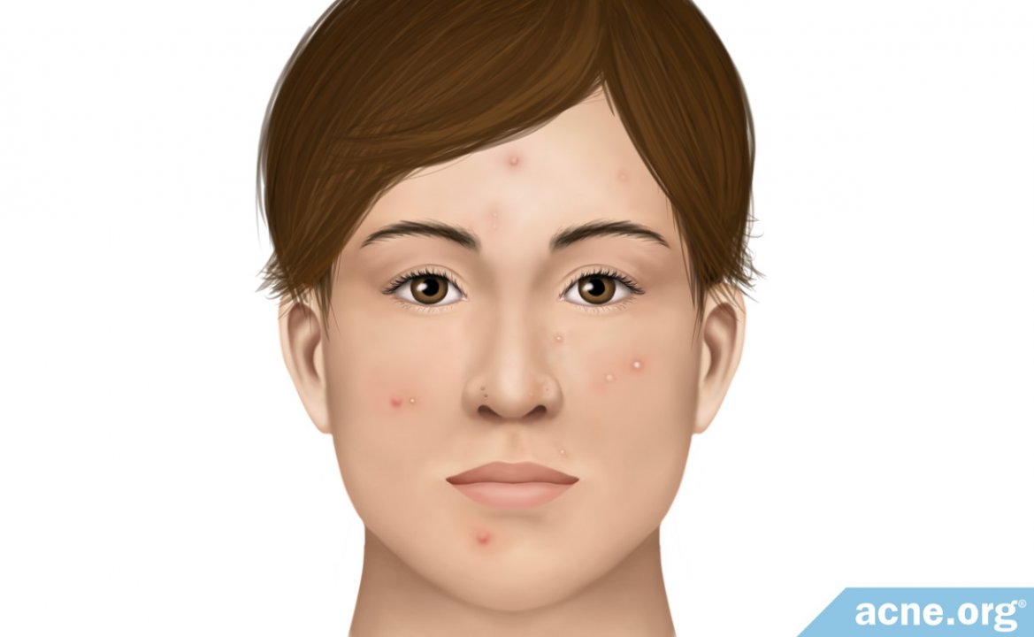 Is Acne a Disease?