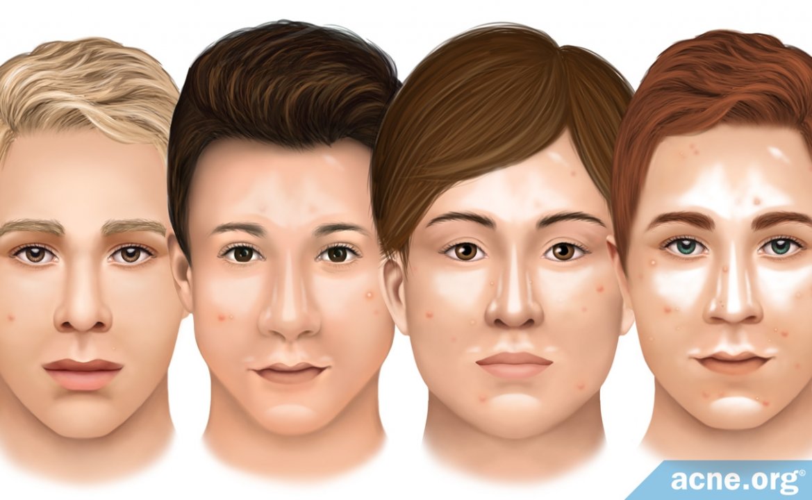 Is Oilier Skin More Prone to Acne?