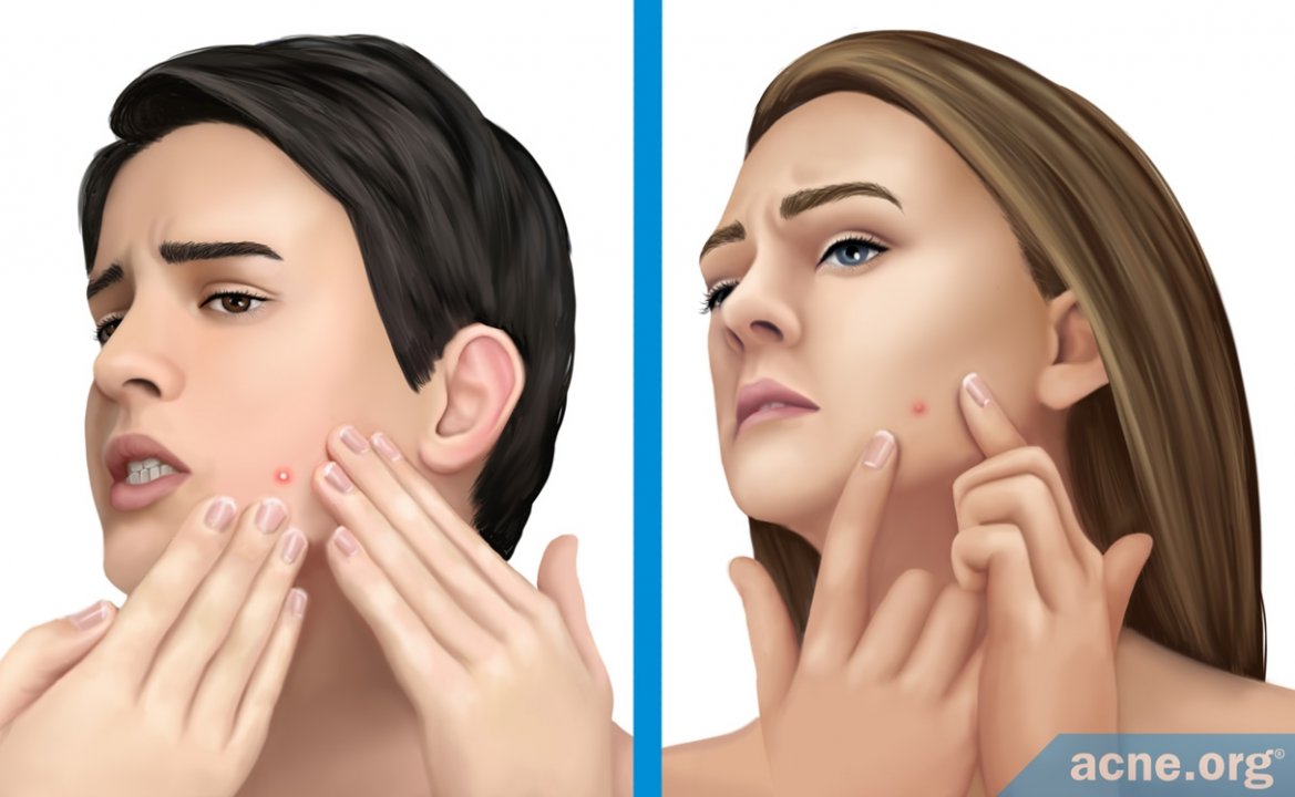 Masturbation and Acne
