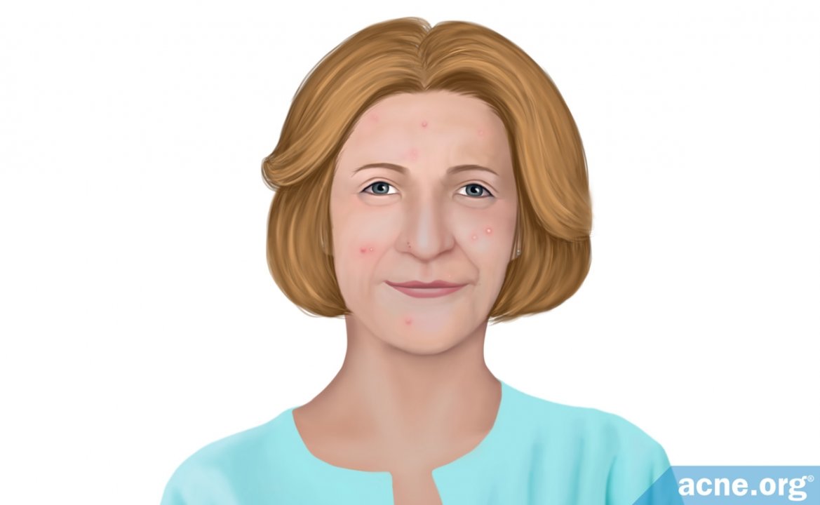 Menopause and Acne