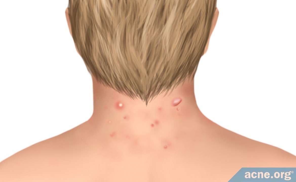 Neck Acne