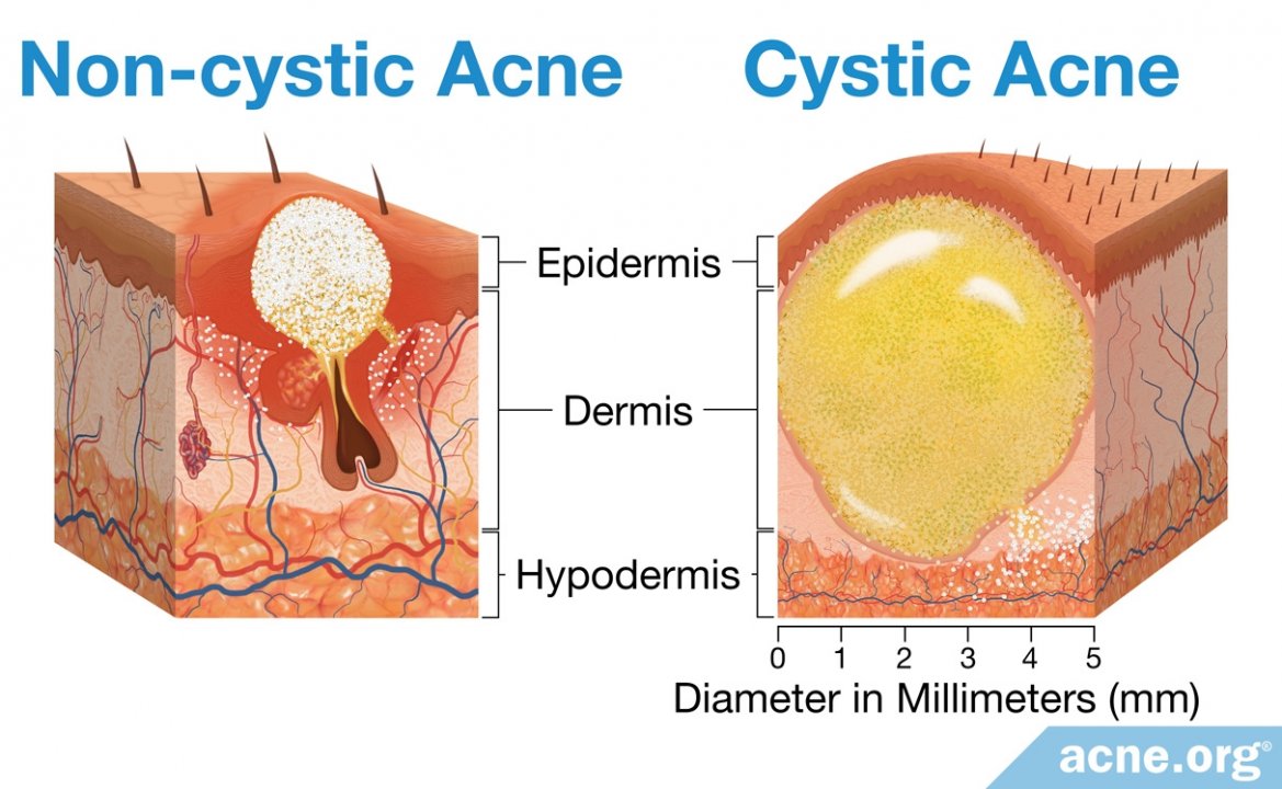 Regular Acne vs. Cystic Acne: What's the Difference?