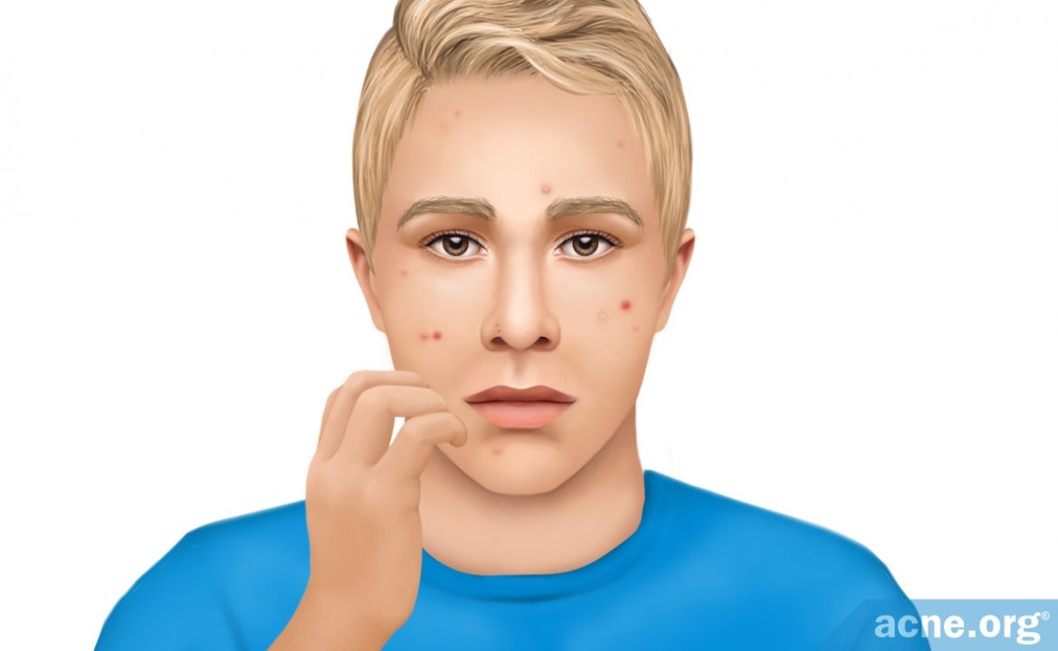 Skin Picking