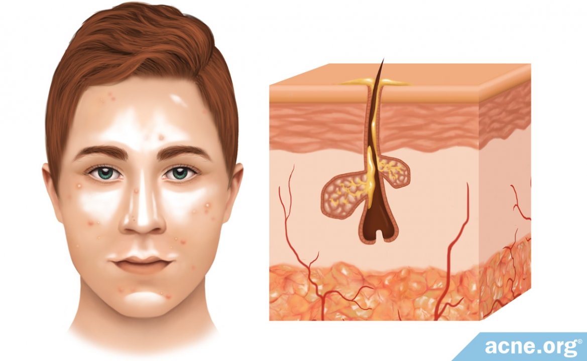 The Role of Sebum (Skin Oil) in Acne