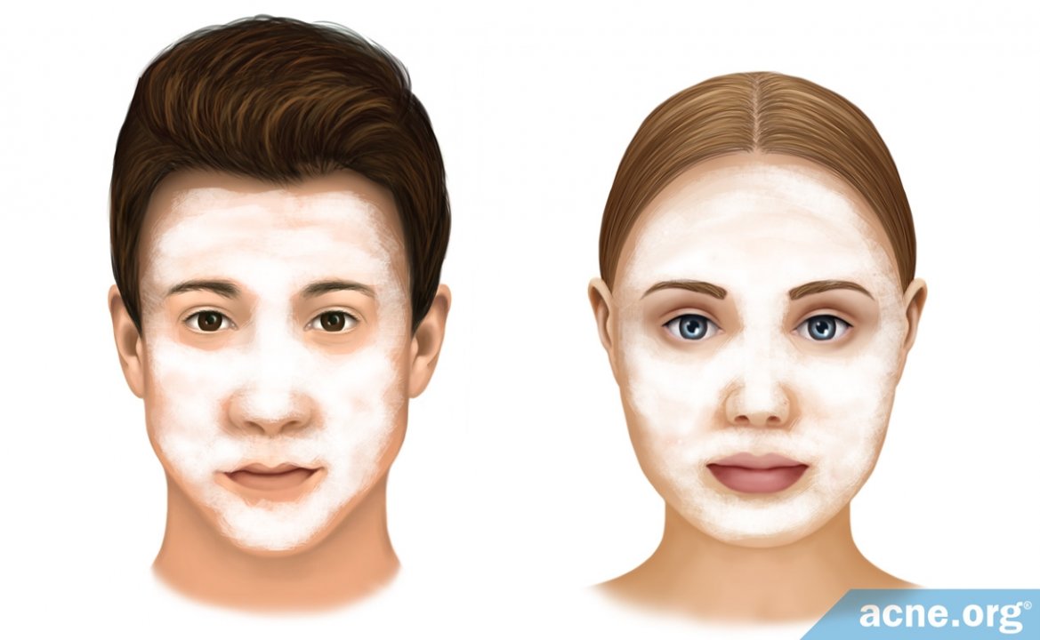 Treating Acne in Male vs. Female Skin