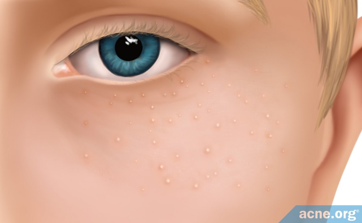 What Are Milia, and Do They Relate to Acne?