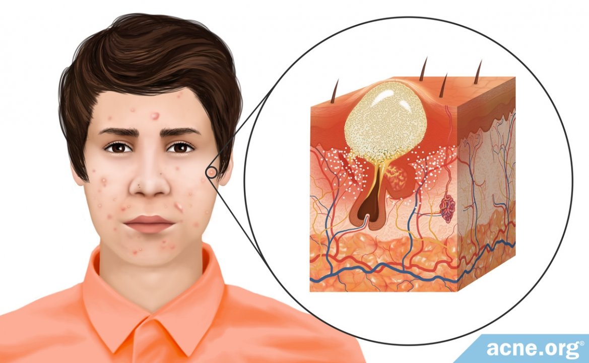 What Is Acne?