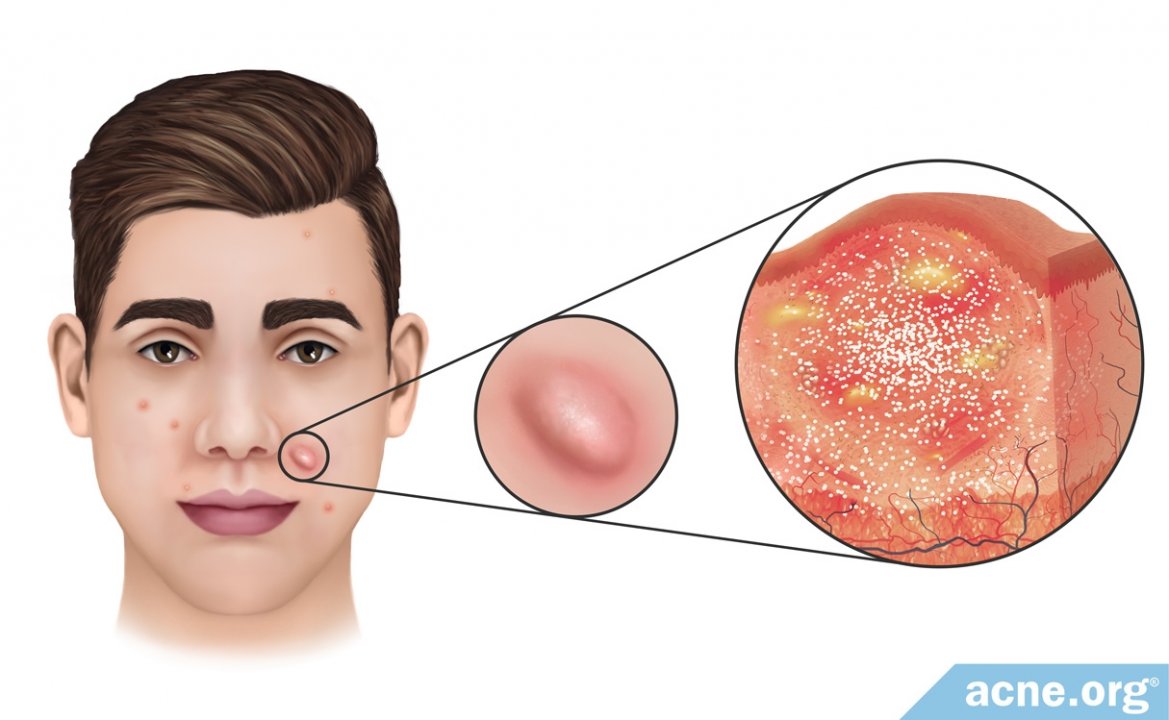 What Is an Acne Nodule?