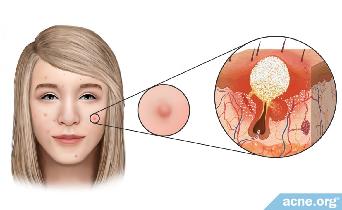 What Is an Acne Papule?