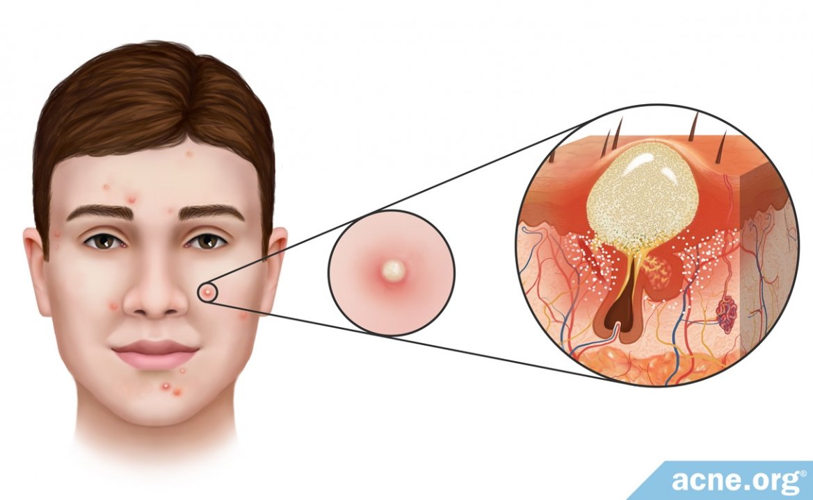 What Is an Acne Pustule?