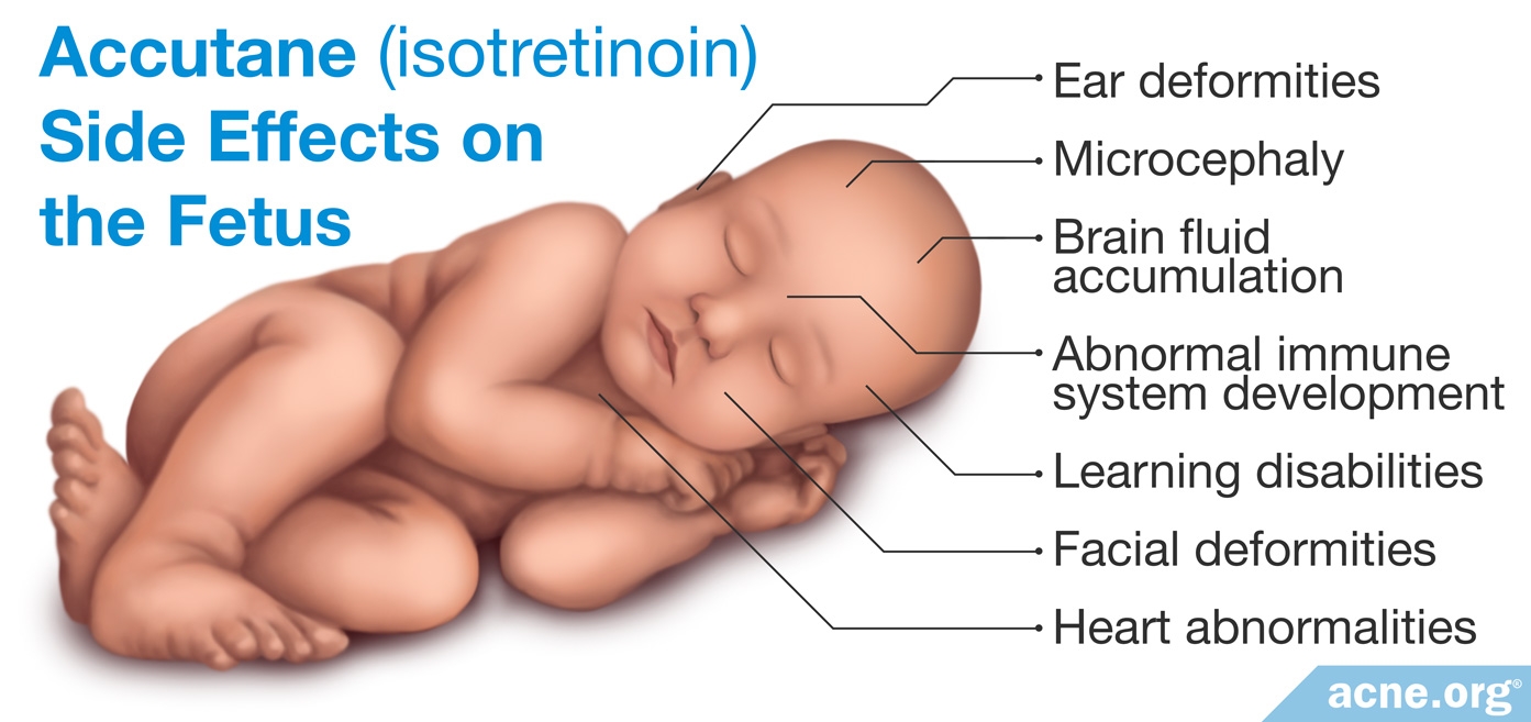 Accutane (isotretinoin) in Pregnancy - Acne.org