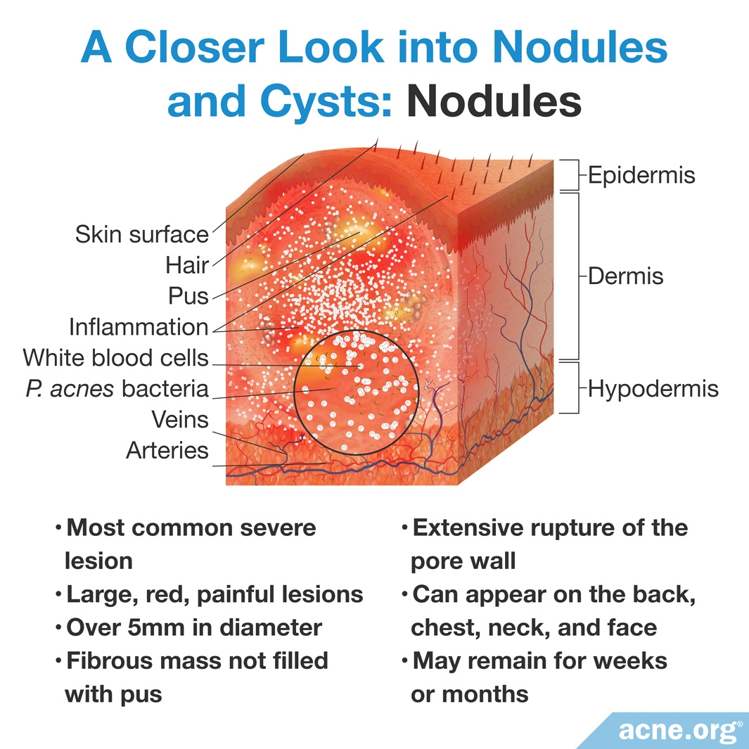Cystic Acne On The Body