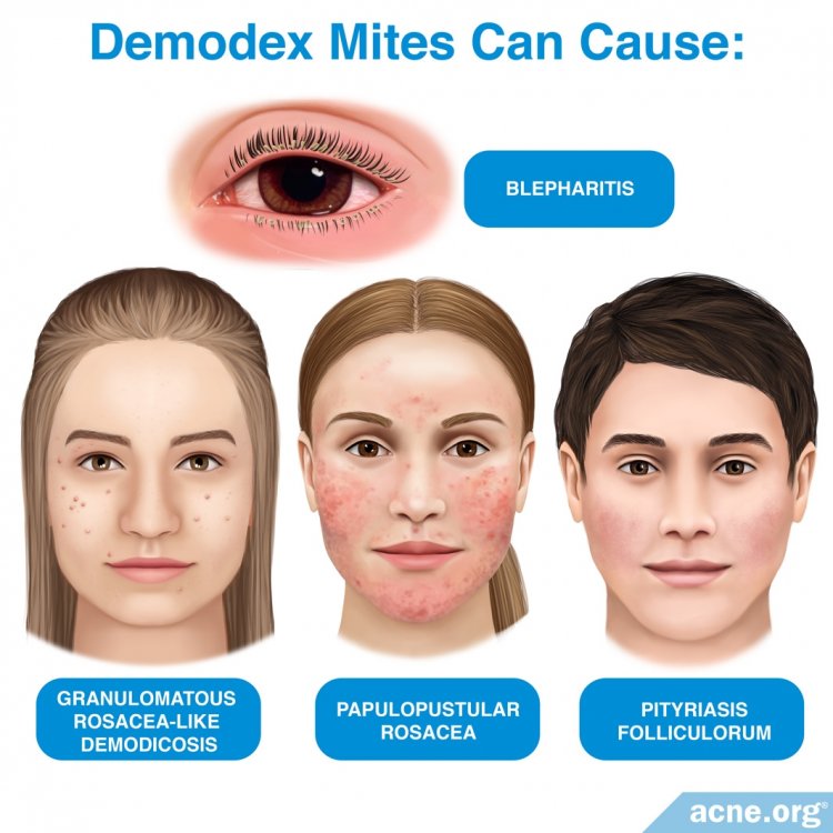 Can Demodex Mites Cause Problems?