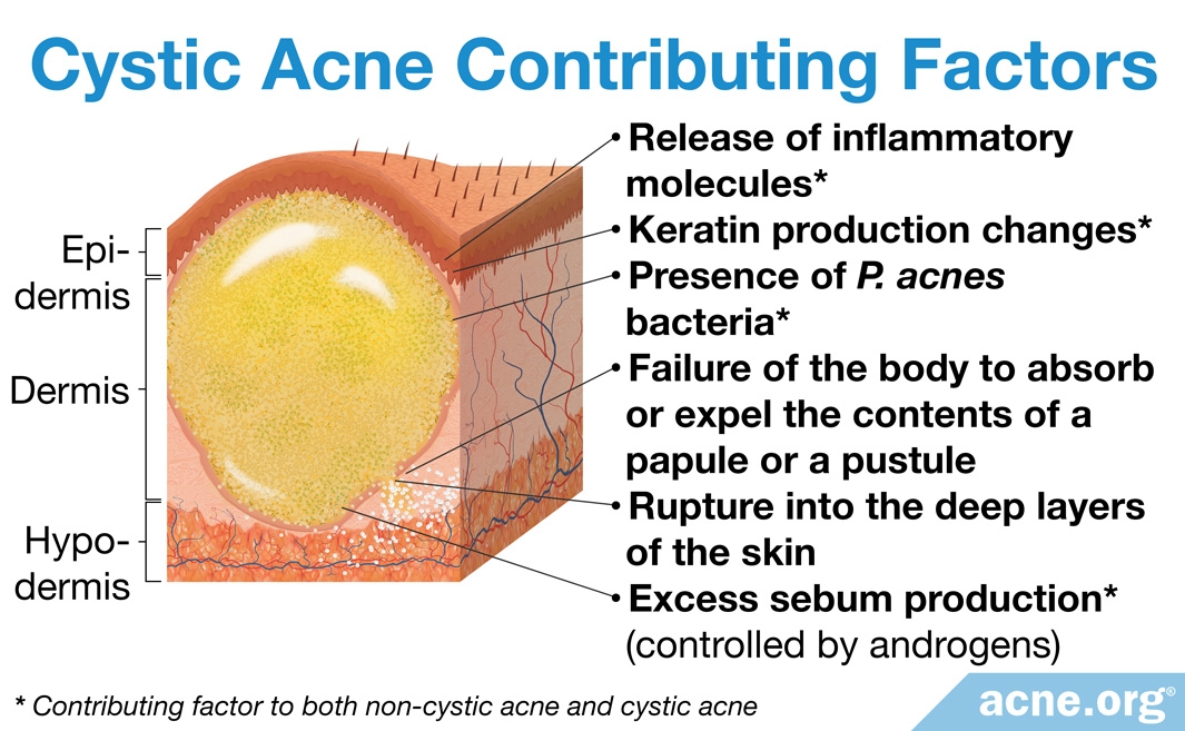 regular-acne-vs-cystic-acne-what-s-the-difference-acne