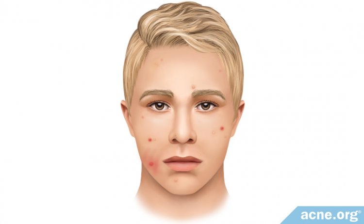 Excoriation Disorder