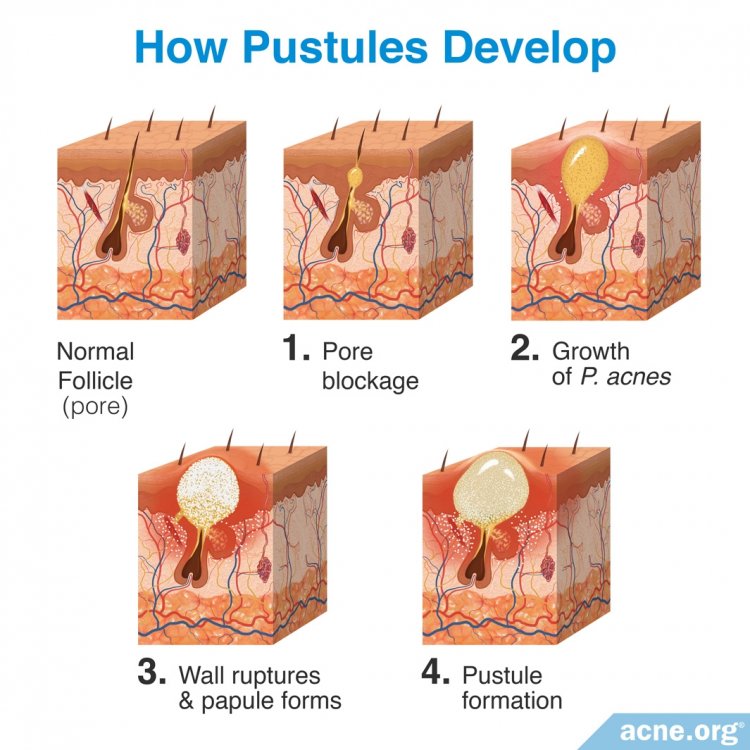 How Pustules Develop