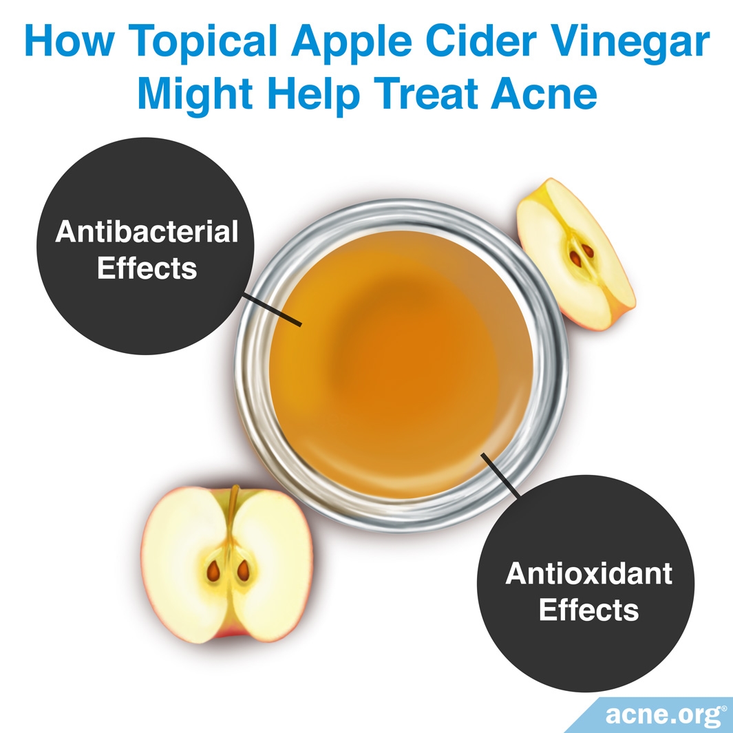 Topical Apple Cider Vinegar And Acne