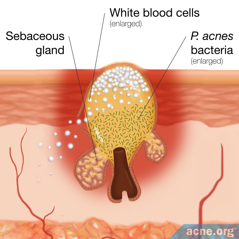 baking-soda-and-acne-acne