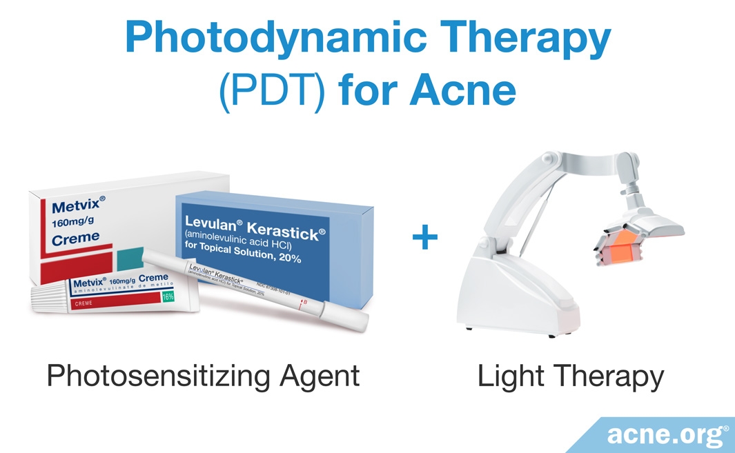 Does Photodynamic Therapy Work for Acne?  Acne.org