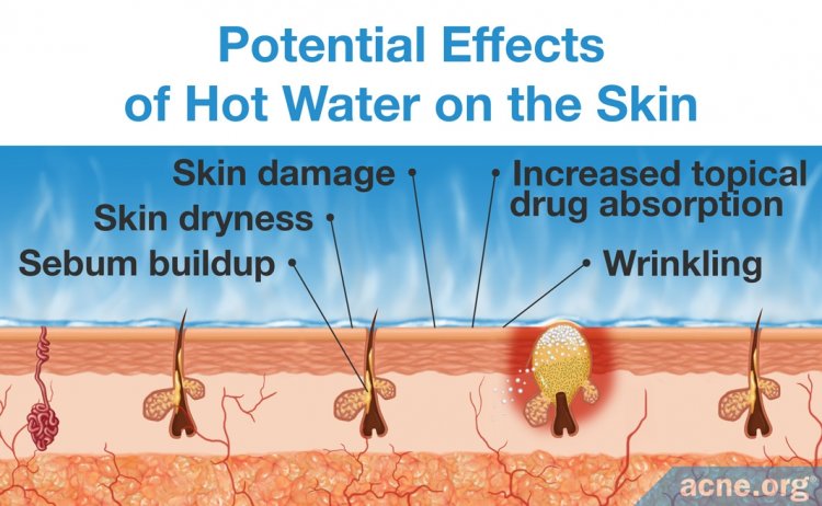 Should You Wash Your Skin With Hot Or Cold Water Acne