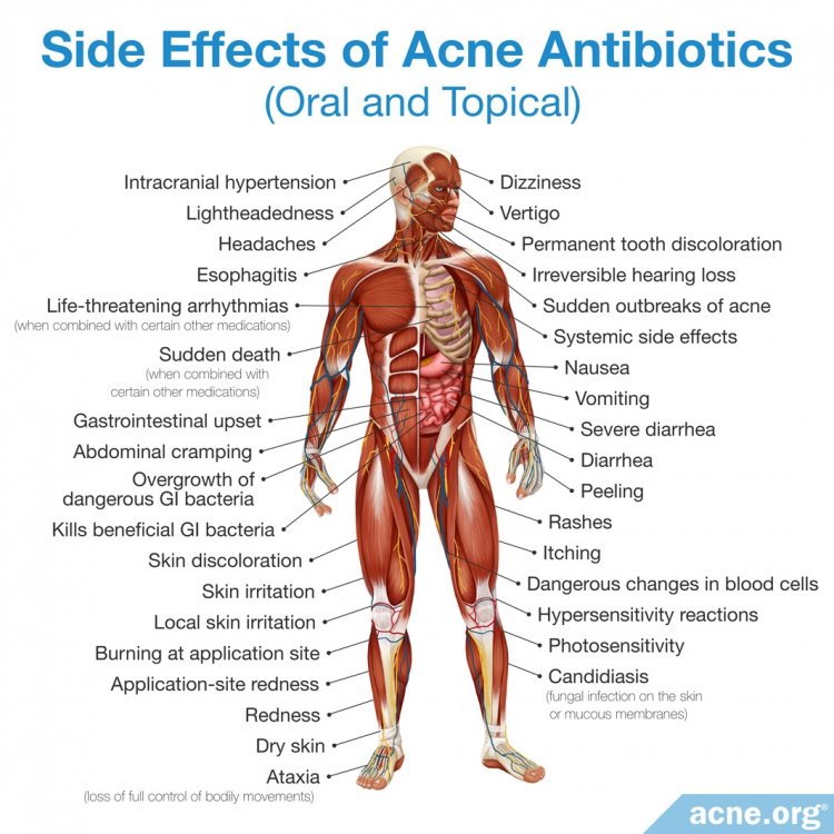 Side Effects of Oral and Topical Antibiotics for Acne
