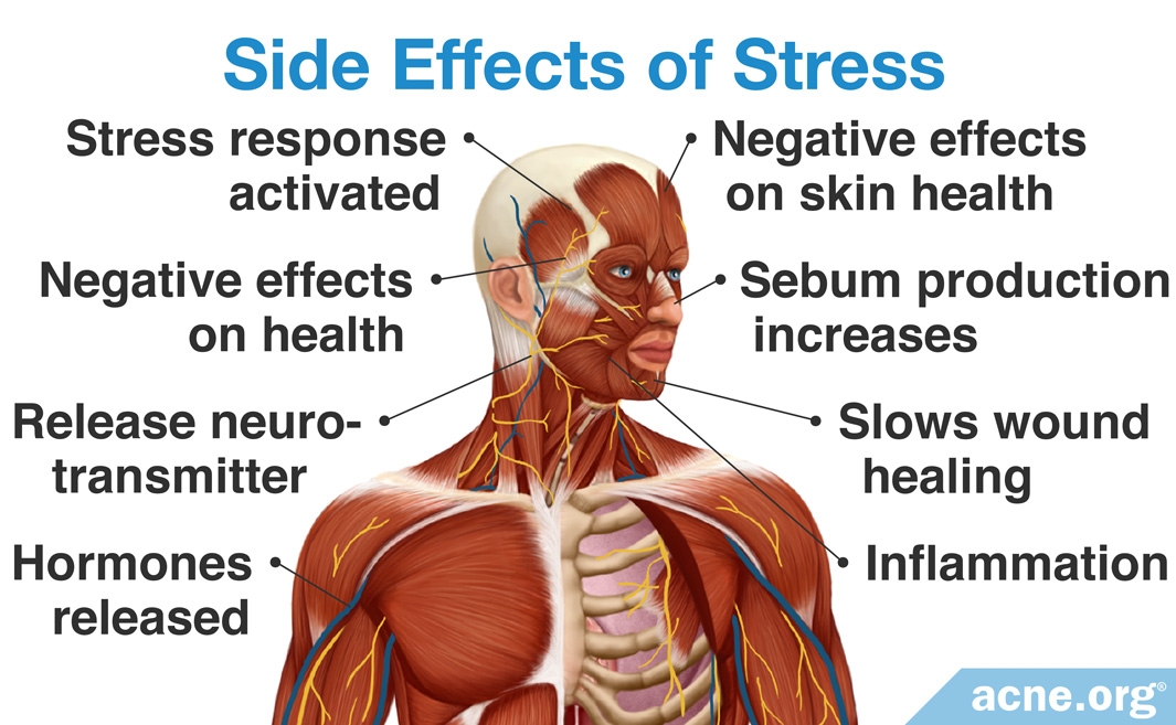 does-stress-affect-acne-acne