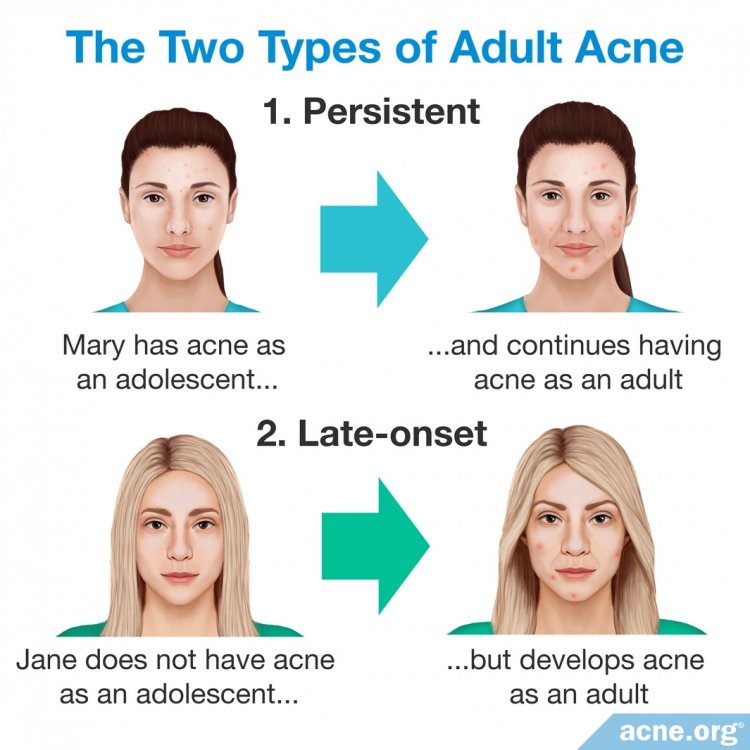 The Two Types of Adult Acne