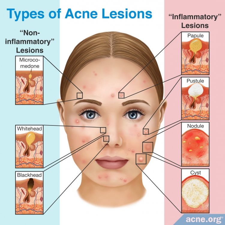 Types of Acne Lesions