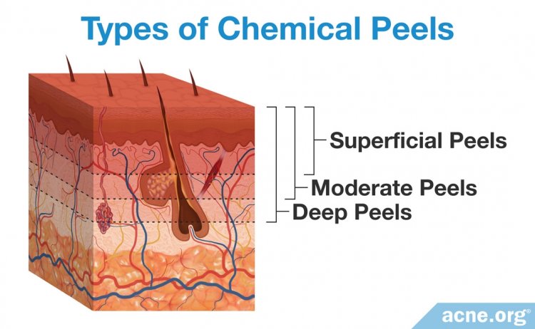 chemical-peels-for-acne-do-they-work-acne