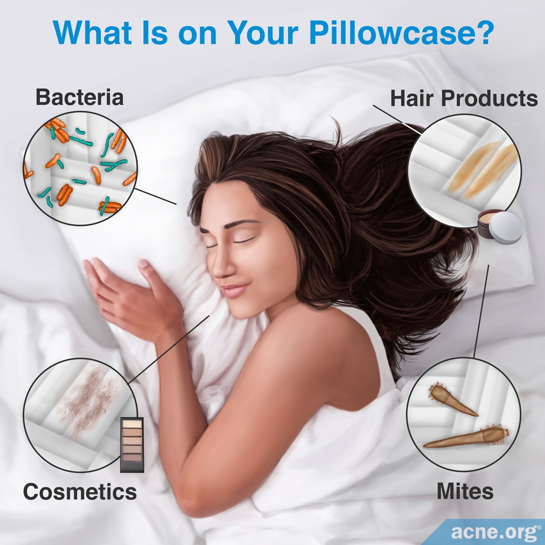pillowcases good for acne