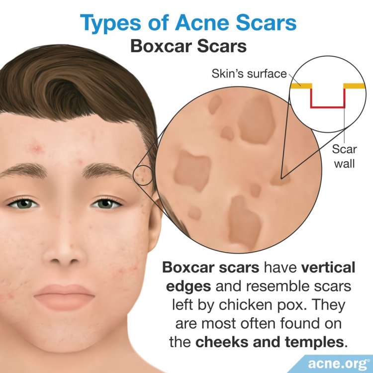 Boxcar Scars