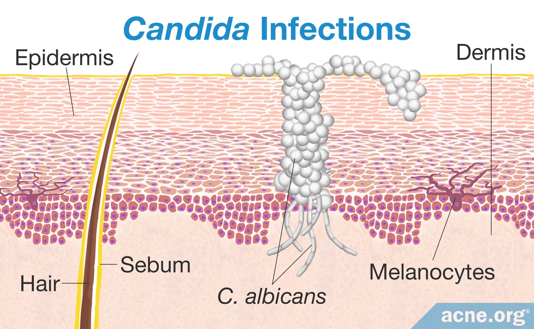 can-candida-cause-acne-acne