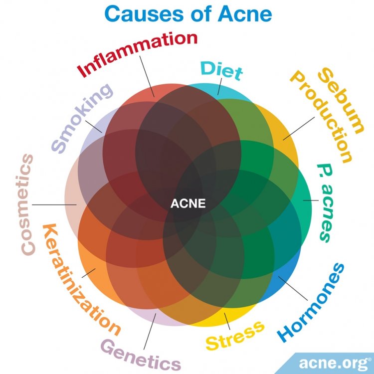 Causes of Acne