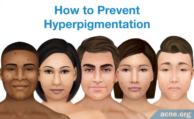 How to Prevent Hyperpigmentation