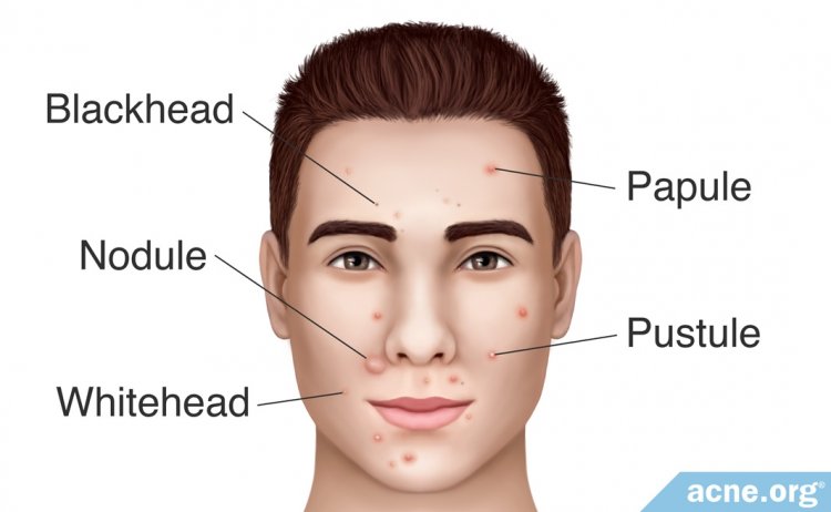 Types of Acne Lesions