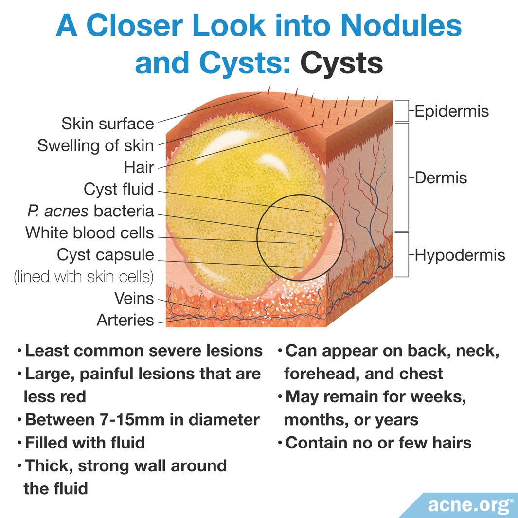 รวมกัน 98+ ภาพ Sebaceous Cyst คืออะไร ความละเอียด 2k, 4k