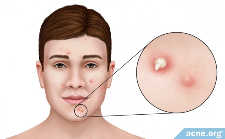 Acne Pustule