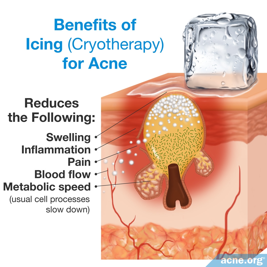 Does Ice Help Acne Examples and Forms