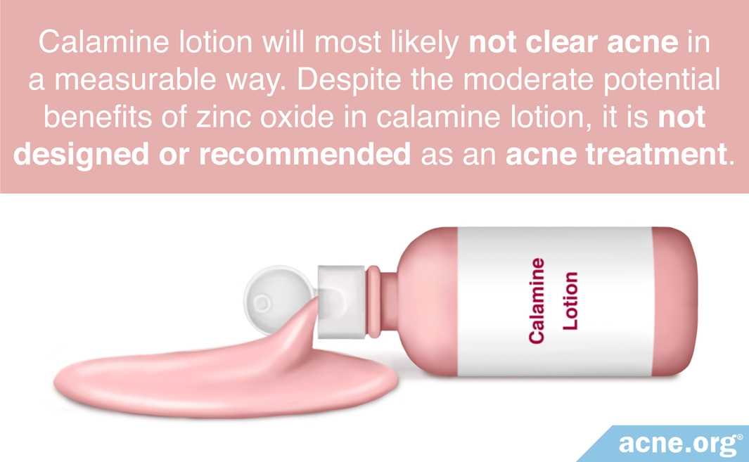 Does Calamine Lotion Clear Acne? - Acne.org