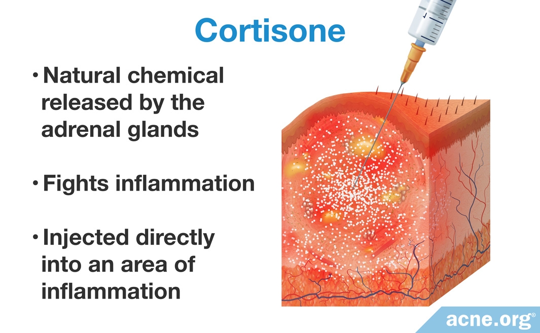 Cortisone Shots for Severe Acne Nodules and Cysts