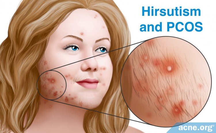 Hirsutism and PCOS