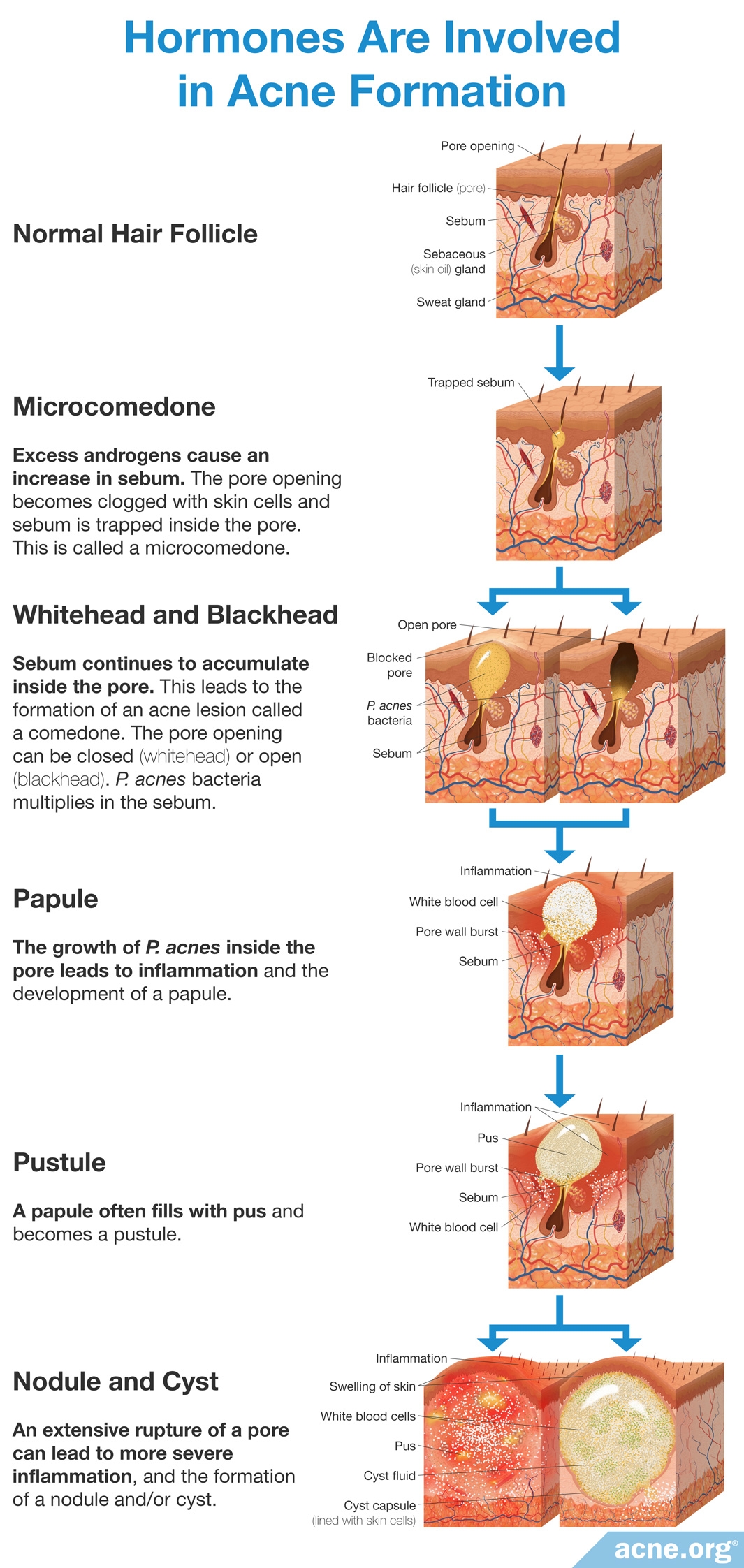 acne-face-map-meaning-of-pimple-location-in-2020-face-mapping-acne