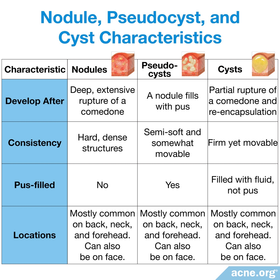 What Is Cystic Acne 