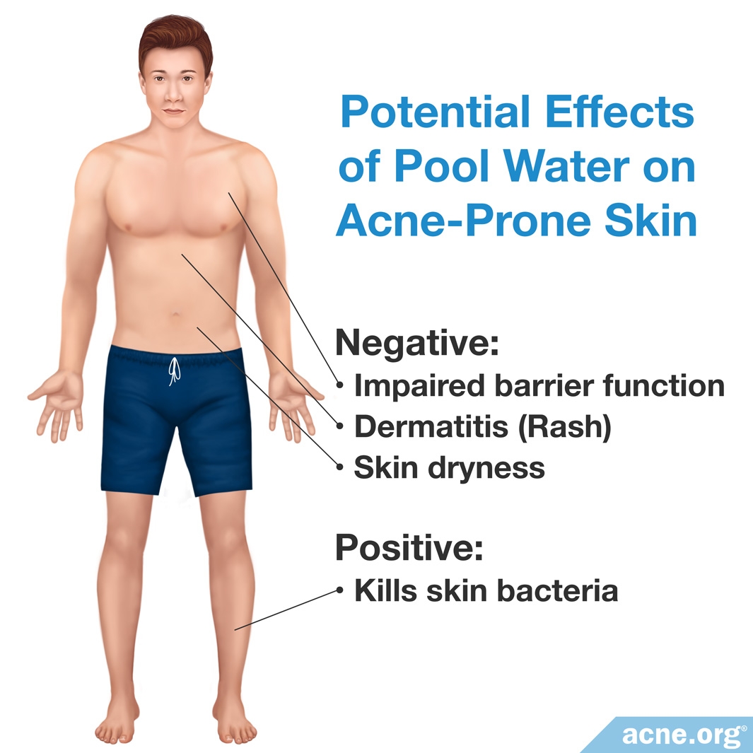 can water make acne worse