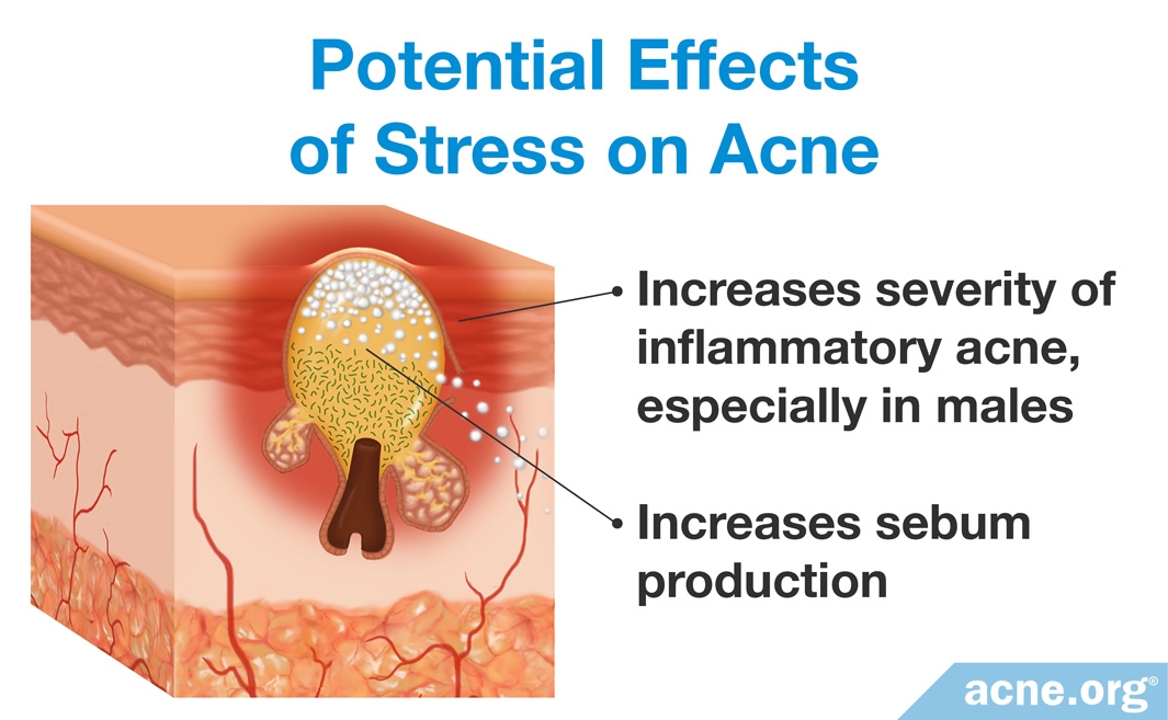 does-stress-affect-acne-acne