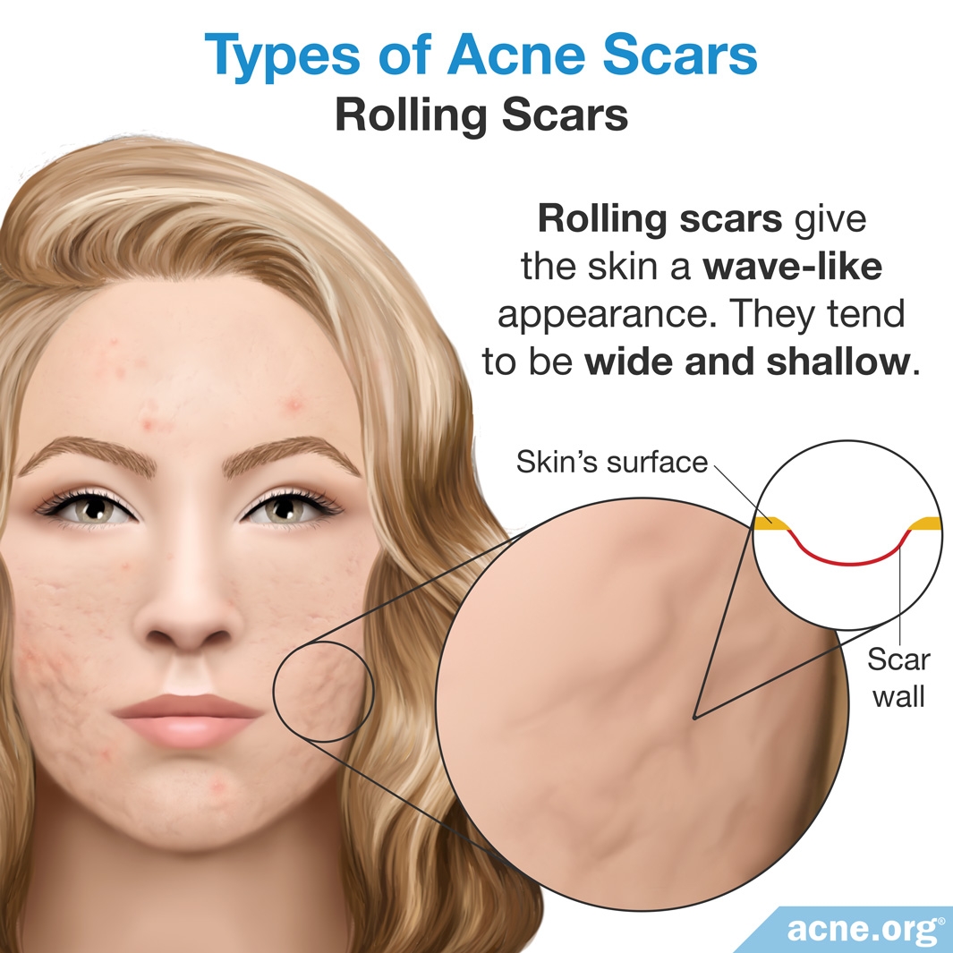 Rolling Scars