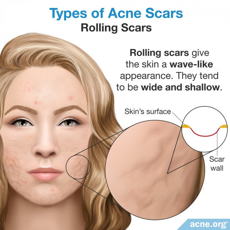 Rolling Scars