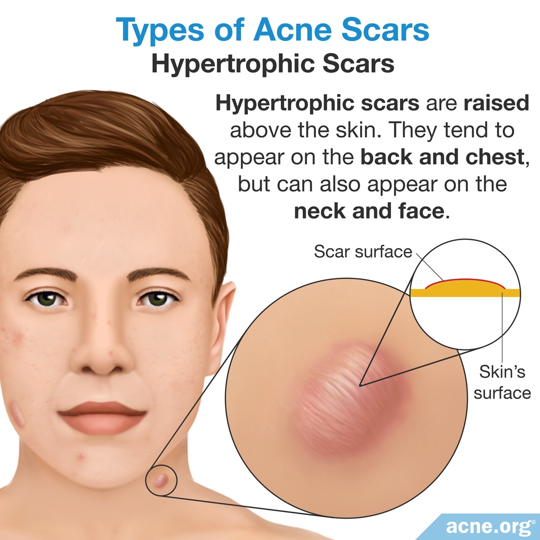 Hypertrophic Scars