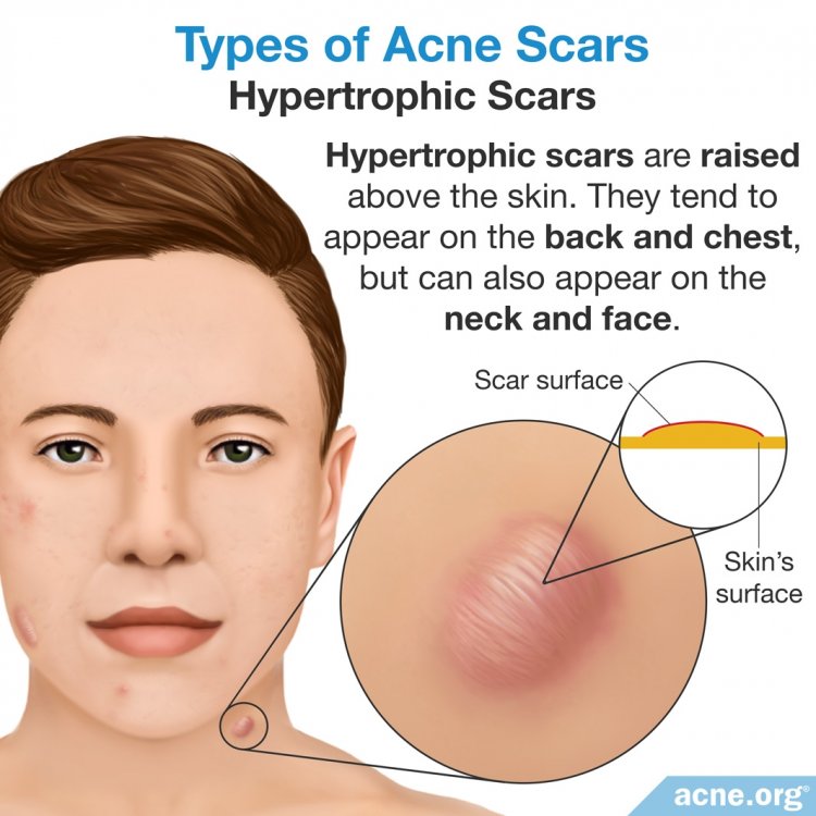 Hypertrophic Scars