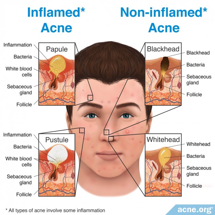 Inflamed Acne vs. Non-inflamed Acne